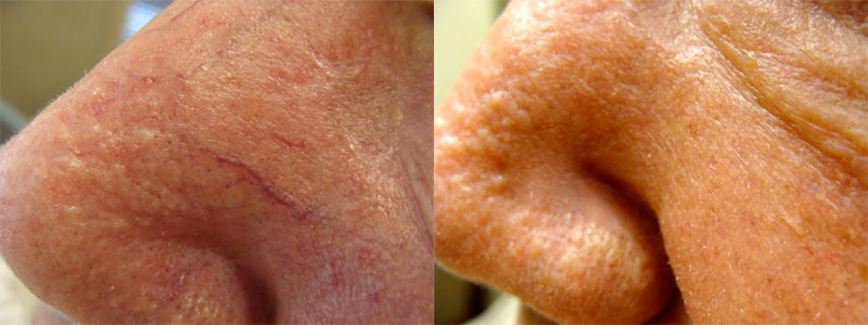 Laser Vein Treatment Before and After Photo by Dr. Bundy in Hilton Head Island South Carolina