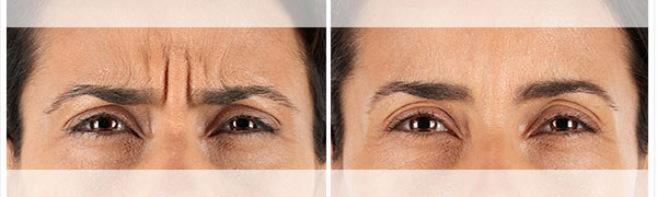 Botox Before and After Photo by Dr. Bundy in Hilton Head Island South Carolina