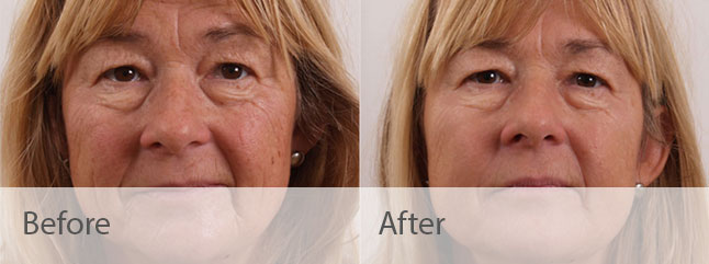 Exilis Before and After Photo by Dr. Bundy in Hilton Head Island South Carolina