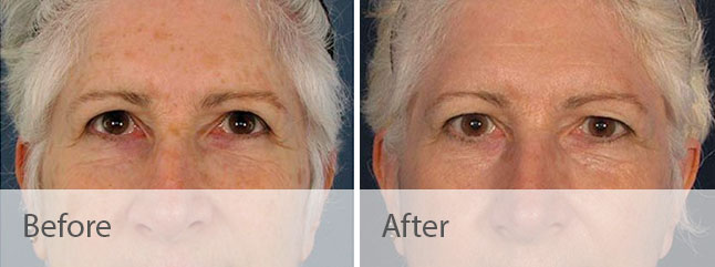 ResurFX Before and After Photo by Dr. Bundy in Hilton Head Island South Carolina
