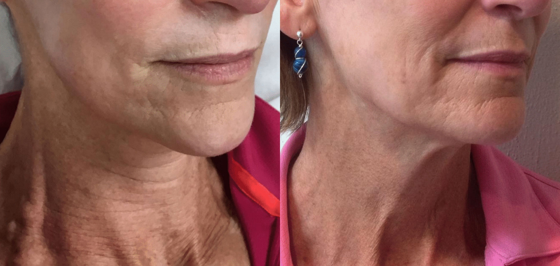 Fraxis DUO Before and After Photo by Dr. Bundy in Hilton Head Island South Carolina