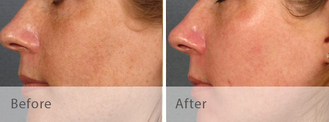 Lumenis M22 Intense Pulsed Light Photo Rejuvenation Before and After Photo by Dr. Bundy in Hilton Head Island South Carolina