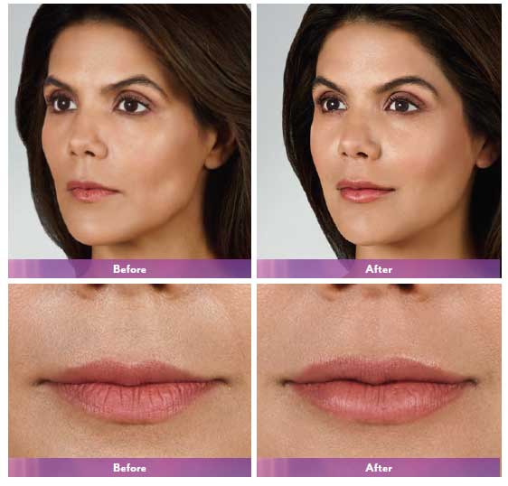 Juvederm Ultra XC Before and After Photo by Dr. Bundy in Hilton Head Island South Carolina