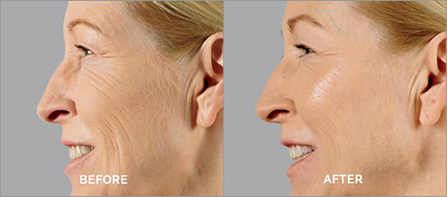 Juvederm Voluma Before and After Photo by Dr. Bundy in Hilton Head Island South Carolina