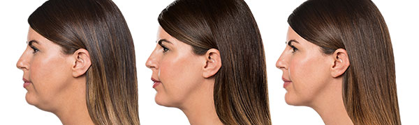 Kybella Before and After Photo by Dr. Bundy in Hilton Head Island South Carolina