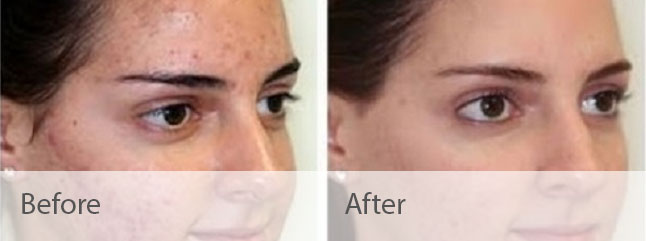 Microdermabrasion Before and After Photo by Dr. Bundy in Hilton Head Island South Carolina