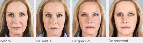 Sculptra Before and After Photo by Dr. Bundy in Hilton Head Island South Carolina