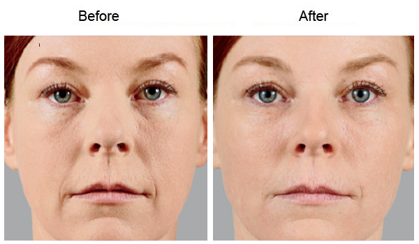 Juvederm Voluma XC Before and After Photo by Dr. Bundy in Hilton Head Island South Carolina