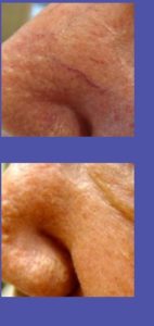 LASER VEIN TREATMENT