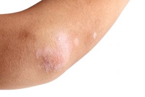 Psoriasis Treatment