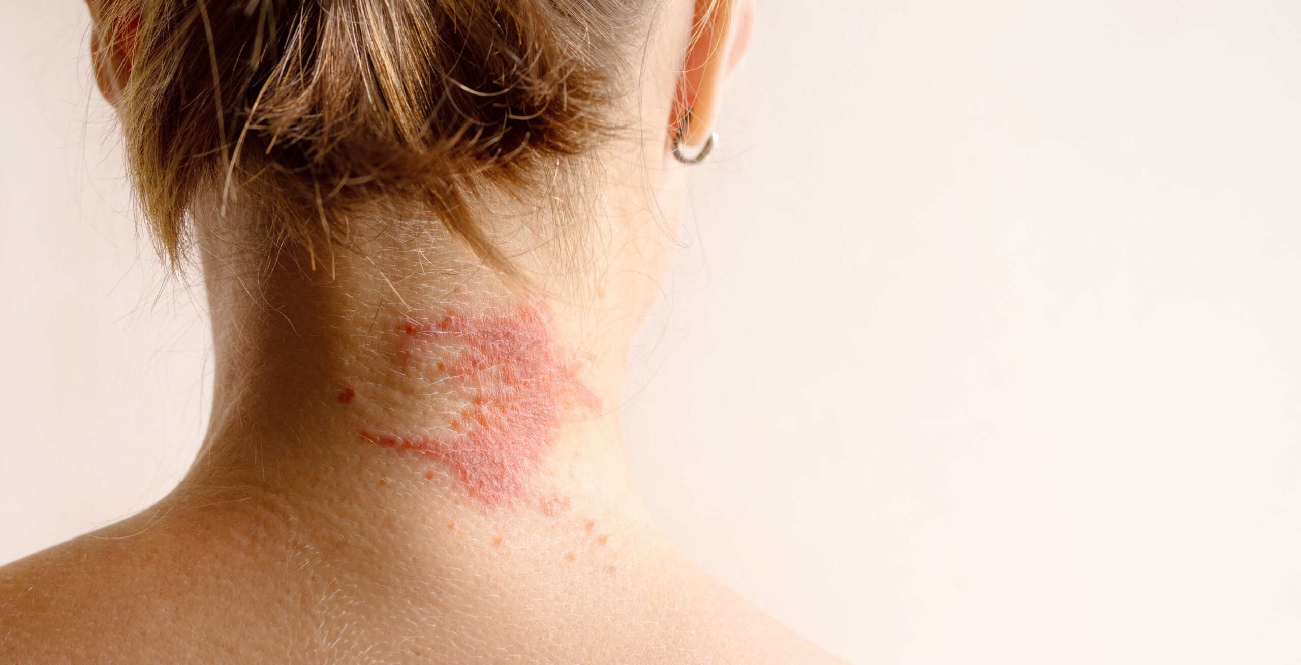 Manifestation of atopic dermatitis as a red itchy spot on a woman’s neck, close up, rear view, copy space. Dermatology, allergy, itching, red spot or rash on skin