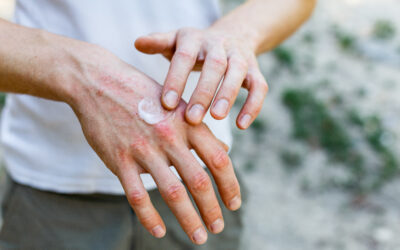Eczema Relief: Managing Symptoms With a Healthy Lifestyle